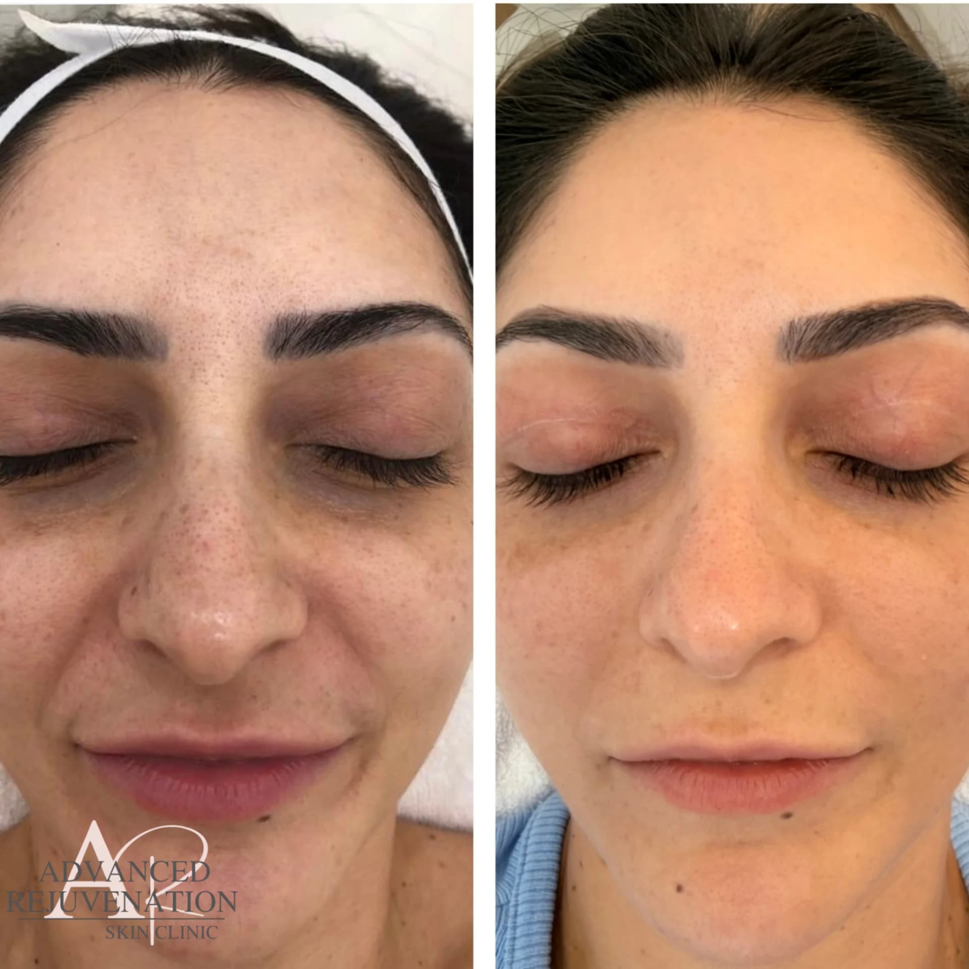 Does HIFU Actually Work? Honest Results From Our Clients